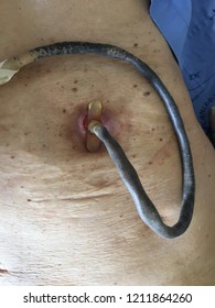 Closed Up Percutaneous Endoscopic Gastrostomy (P.E.G) Or Tube Feeding Patient Stomach.