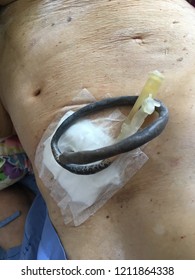 Closed Up Percutaneous Endoscopic Gastrostomy (P.E.G) Or Tube Feeding Patient Stomach.