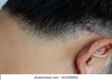 Seborrheic Dermatitis Fungal Skin Infection Scalp Stock Photo (Edit Now ...