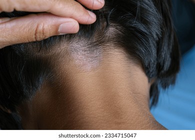 Closed up of ringworm (tinea) on head of Asian girl (Dermatitis). skin with psoriasis. Seborrheic dermatitis. Chronic inflammation on the skin) Appears as a red, itchy and scaly dandruff on the head.