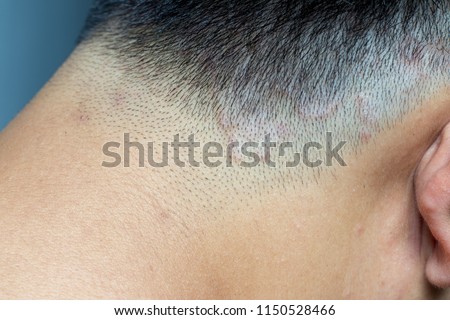 Closed up of ringworm (tinea) on head of asian man (Dermatitis)