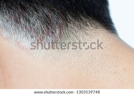 Closed up of ringworm (tinea) on head of asian man (Dermatitis)