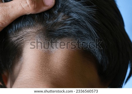 Closed up of ringworm (tinea) on head of Asian girl (Dermatitis). skin with psoriasis. Seborrheic dermatitis. Chronic inflammation on the skin) Appears as a red, itchy and scaly dandruff on the head.