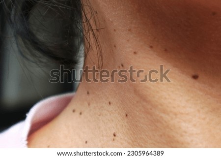 Closed up the skin tags on woman's skin. Acrochordon. Health care concept