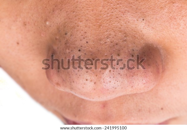 Closedup Pimple Blackheads On Nose Asian Stock Photo Edit Now 241995100
