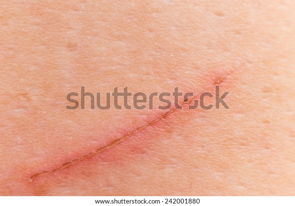 Closedup Wound On Shoulder Due Cuts Stock Photo (edit Now) 242001880