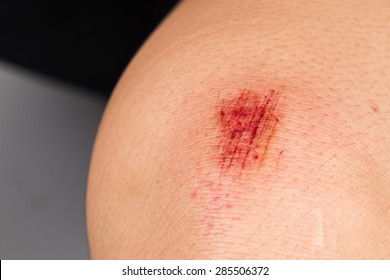 Closely On Bloody Bruise Wound On The Knee 