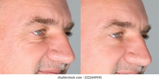Closeup 45-50 years old shows the before and after results of successful blepharoplasty surgery, corrective procedure to remove puffy and swollen bags beneath the eye.
