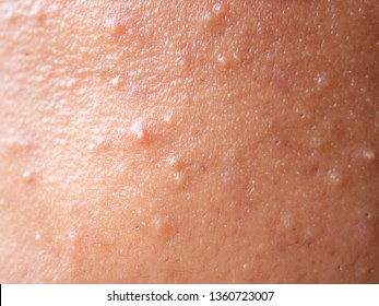 Closeup Acne And Dark Skin Texture Of Woman. 