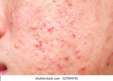 Close-up Acne On Face Skin