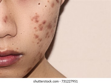 Close-up of acne on the skin, Acne on the face caused by Hormone, The scars, wrinkle and acne inflammation on the face skin