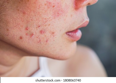 Nahaufnahme einer Akne im Gesicht einer Frau mit Hautausschlag, Narbe und Stelle, die allergisch auf kosmetische Mittel reagiert   
