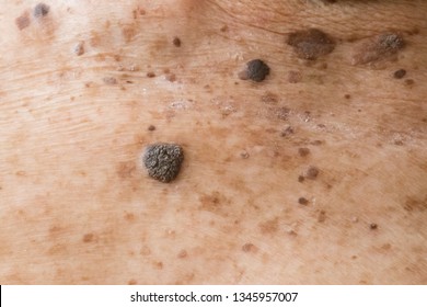 Closeup Of Age Spots Skin (liver Spots) In 90 Years Old Man.Concept : Skin Repair And Treatment For Elderly And Aged People.Selective Focus.