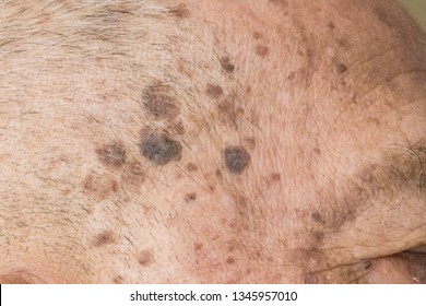 Closeup Age Spots Skin Liver Spots Stock Photo Edit Now