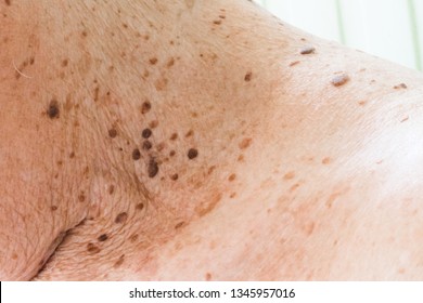 Liver Spots Images Stock Photos Vectors Shutterstock