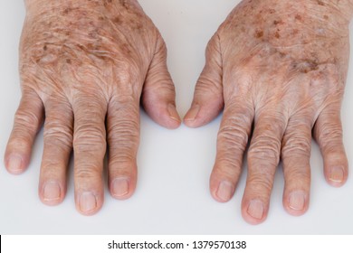 Closeup Of Age Spots Skin (liver Spots) In Hand 90 Years Old Man.Concept : Skin Repair And Treatment For Elderly And Aged People.Selective Focus.