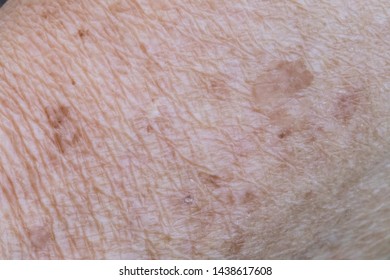 Closeup Age Spots Skin Liver Spots Stock Photo (Edit Now) 1364257061