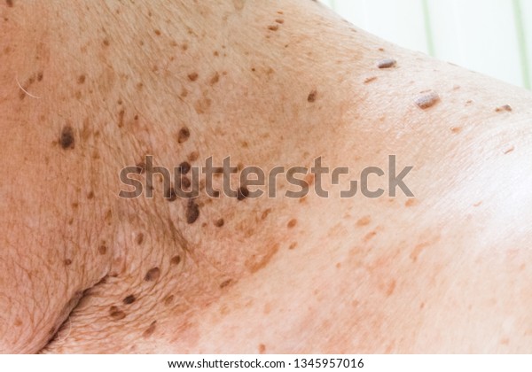 Closeup of age spots skin (liver spots) in 90\
years old man.Concept : Skin repair and treatment for elderly and\
aged people.Selective\
focus.