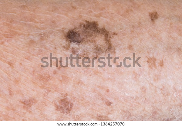 Liver Disease Spots On Skin