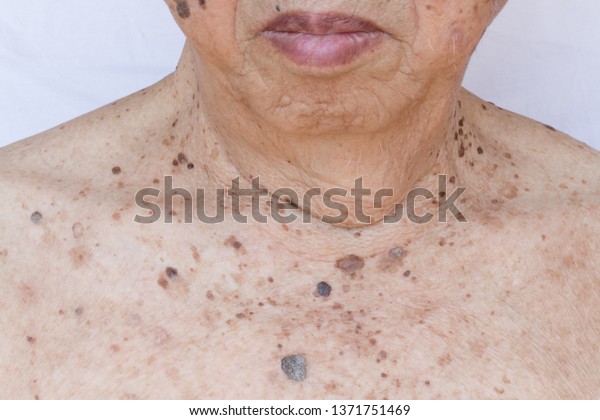 Closeup of age spots skin (liver spots) in 90\
years old man.Concept : Skin repair and treatment for elderly and\
aged people.Selective\
focus.\
