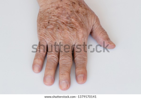 Closeup Age Spots Skin Liver Spots Stock Photo Edit Now