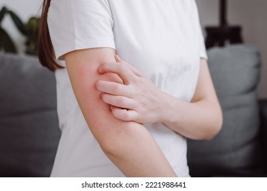 Close-up Of Annoyed Unhealthy Young Female Itching On Her Arm Have Red Rash From Allergy Symptom And From Scratching. Healthcare And Dermatological Problems. Sensitive Skin Allergic Concept