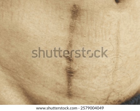 Closeup of the appendectomy stitches on the lower right abdomen.