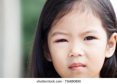 2,975 Conjunctivitis Asian Images, Stock Photos & Vectors 