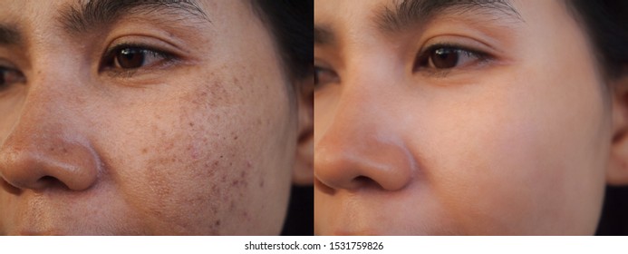 Closeup asian woman before and after dark spot melasma scar acne pigmentation treatment on skin face. Problem skincare and health concept. 