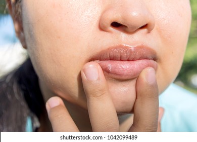 Closeup asian woman face with brittle and dry lips, concept lip salve and wounds