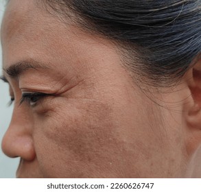 Close-up of Asian woman face with freckles, wrinkles, dark spots and wrinkles, crow's feet on middle-aged woman's face. darkened face. damaged, dry, rough skin and the concept of skin care treatment.