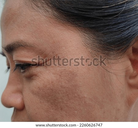 Close-up of Asian woman face with freckles, wrinkles, dark spots and wrinkles, crow's feet on middle-aged woman's face. darkened face. damaged, dry, rough skin and the concept of skin care treatment.