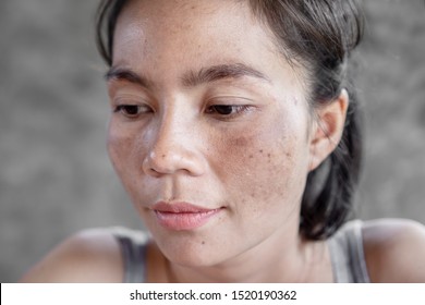 Closeup Asian Woman Face Having Skin Problem With Dark Spot, Freckle From Uv Light 