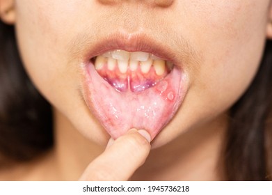 Close-up Asian woman have Aphthous ulcer or Canker sore on mouth at lip - Shutterstock ID 1945736218