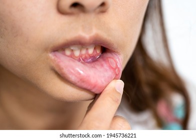 Close-up Asian woman have Aphthous ulcer or Canker sore on mouth at lip - Shutterstock ID 1945736221