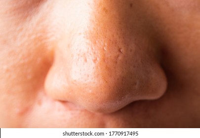 Closeup Asian Young Woman Large Pores Have Freckles Cheek Oily, Acne Pimple On Nose, Studio Shot Isolated On White Background, Healthcare Beauty Skin Face Problem Concept