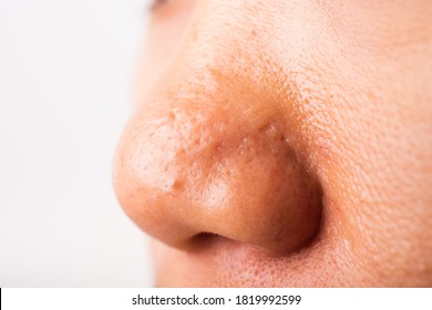 Closeup Asian Young Woman Large Pores Have Freckles Cheek Oily, Acne Pimple On Nose, Studio Shot Isolated On White Background, Healthcare Beauty Skin Face Problem Concept