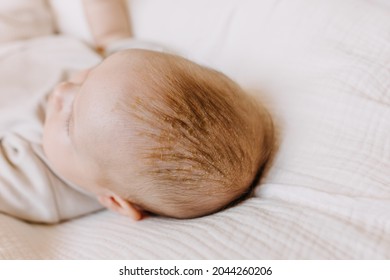 Closeup Of Baby Head With Cradle Cap. Dry Skin On Baby Scalp.