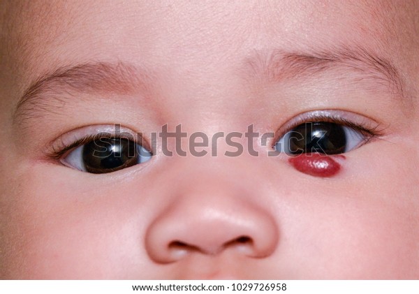 目の近くの皮膚に点在する小児血管腫赤い痣 イチゴの痕とも呼ばれる を持つ赤ちゃんの顔の接写 小児血管腫 Ih は小児期に最も多く見られる腫瘍です の写真素材 今すぐ編集