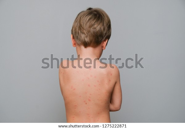 Closeup Back Neck Full Blisters Scar Stock Photo 1275222871 | Shutterstock