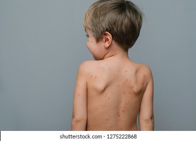 Closeup Back Neck Full Blistersscar Rash Stock Photo 1275222868 ...