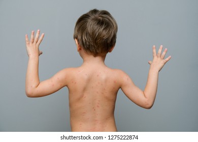 Closeup Back Neck Full Blistersscar Rash Stock Photo 1275222874 ...