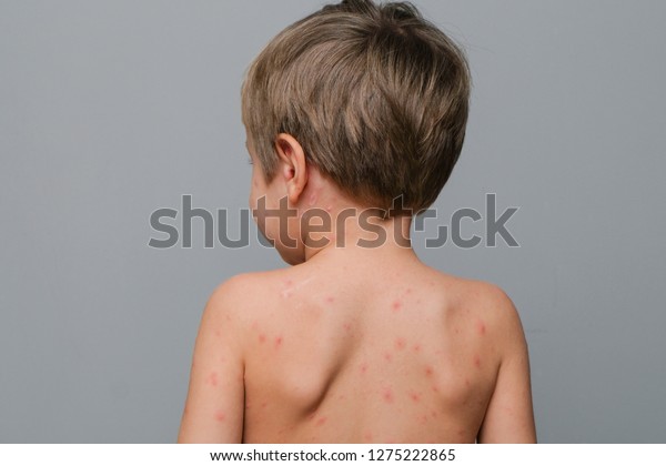 Closeup Back Neck Full Blistersscar Rash Stock Photo 1275222865 ...