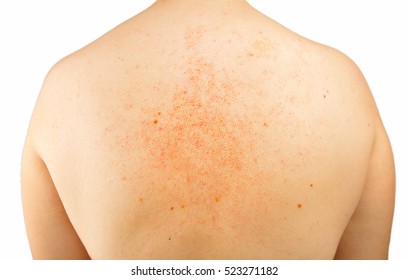 Closeup Of Back Of Person With Eczema Skin Caused By The Dermatitis And Psoriasis