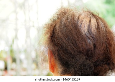 Imagenes Fotos De Stock Y Vectores Sobre Hair Top Of Head