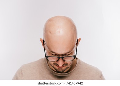 Closeup Of Bald Male Head After Oncology Operation. Brain Tumor Irradiation And Chemotherapy Marks. Survivor Patient After Cancer. Hairless Man With Scars. Skin Irritation. Neurosurgery Operation