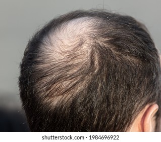 Close-up Of A Bald Spot On A Man's Head. Disease