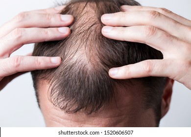 Close-up balding head of a young man on a white isolated background. - Shutterstock ID 1520606507
