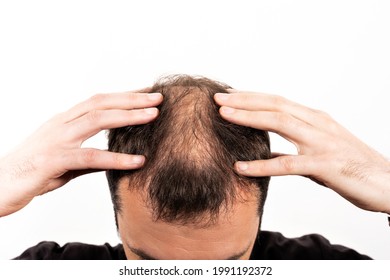 Close-up Balding Head Of A Young Man On A White Isolated Background.