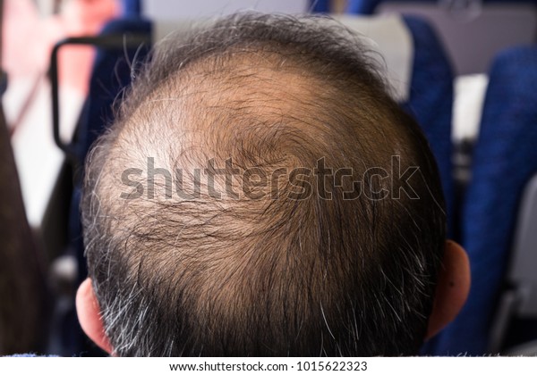 Closeup Balding Thinning Hair Man Crown Stock Photo Edit Now